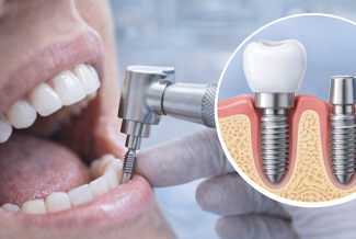 İmplantasyon ve Cerrahi Uygulamalar
